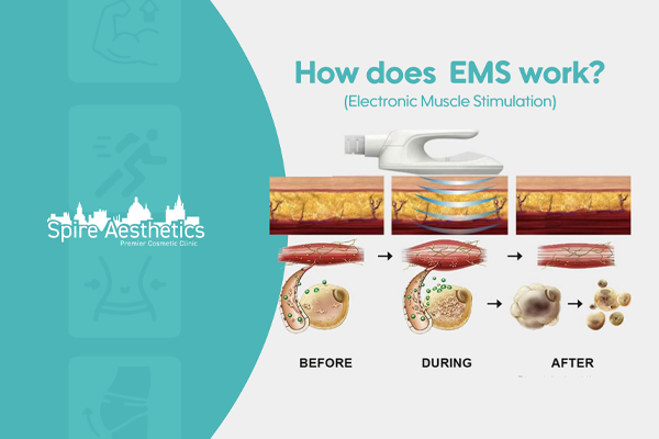 EMS treatment for post pregnancy weight loss treatment Marlborough