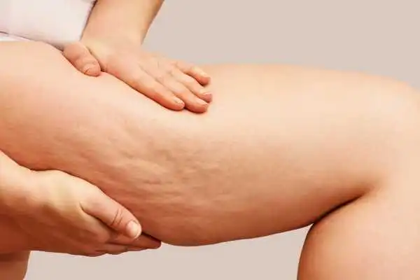 Image of woman showing leg with cellulite Marlborough