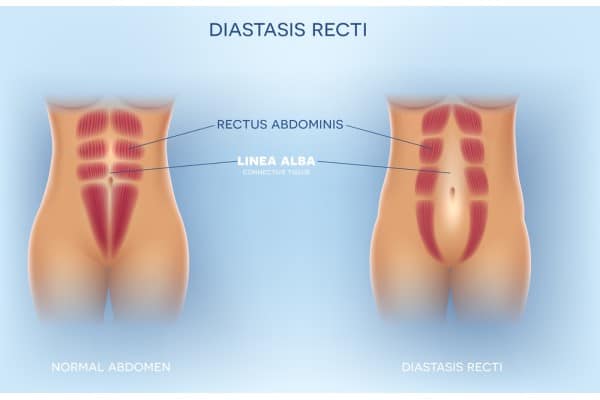 What Non-Surgical Options Are Available for Diastasis Recti Marlborough?