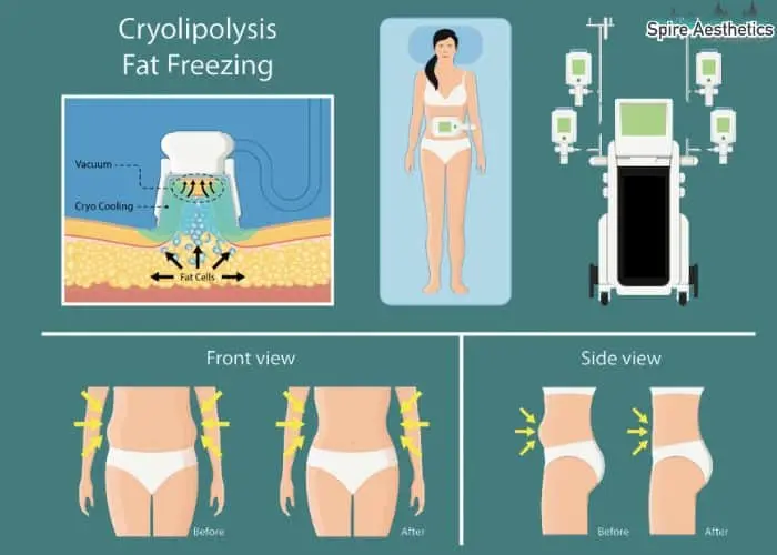 Fat freezing treatment Marlborough benefits for competitions to remove stubborn fat deposits.