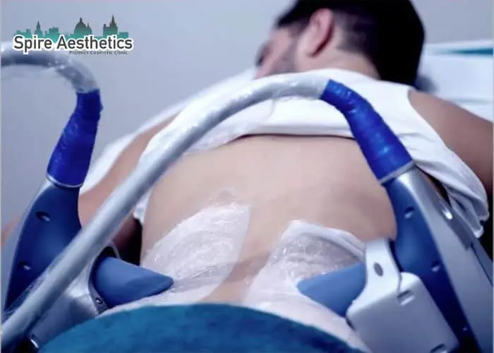 Man having fat freezing treatment done on love handles before a competitions Marlborough to create a sculpted look.
