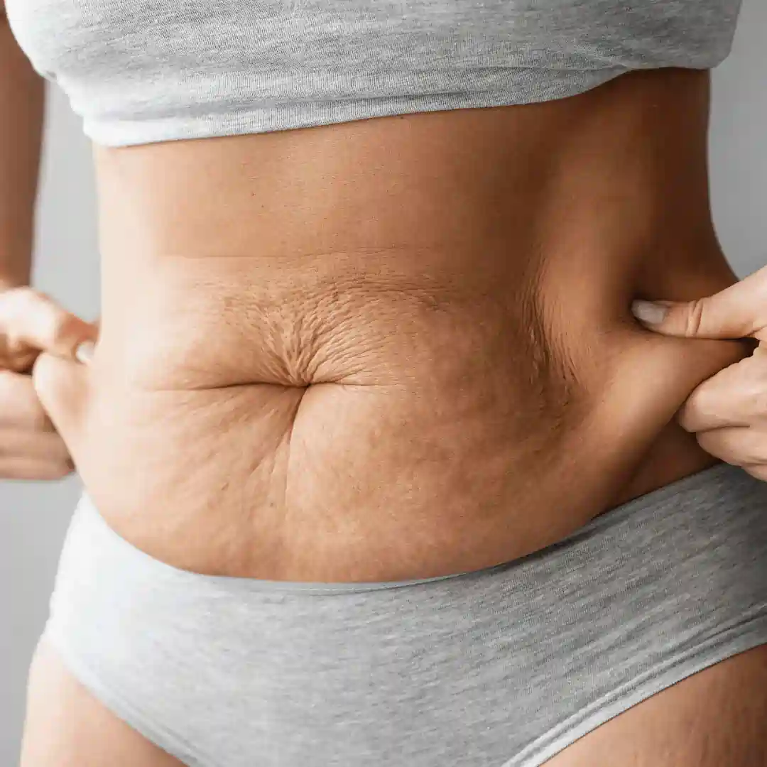 Is It Normal to Have Loose Skin After Pregnancy Marlborough?