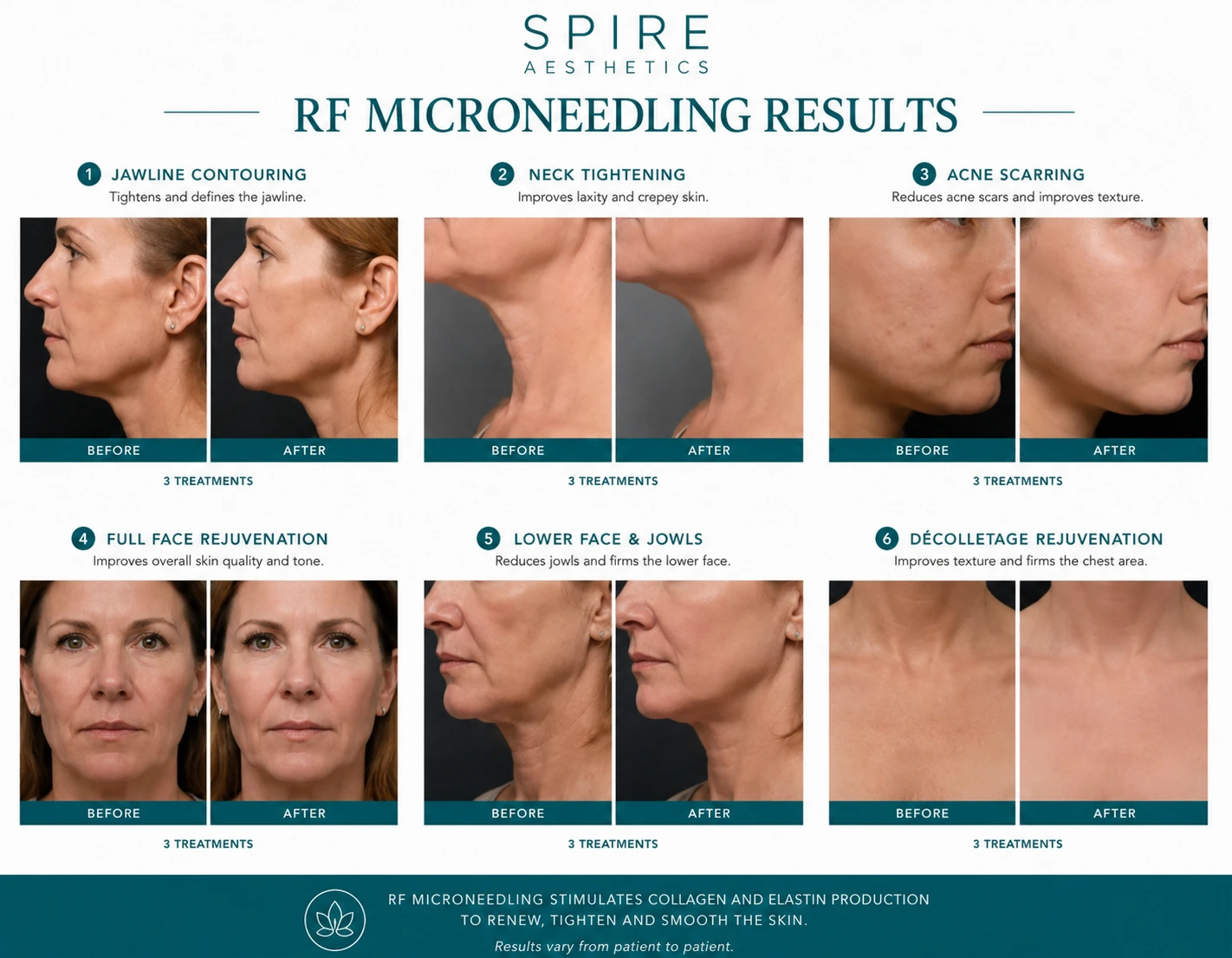 RF Microneedling Skin tightening Marlborough results