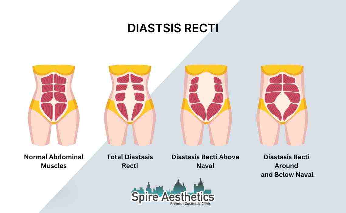 Is Non-Surgical Diastasis Recti Treatment Right for You? Common Concerns Answered Marlborough